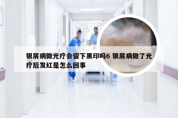 银屑病做光疗会留下黑印吗6 银屑病做了光疗后发红是怎么回事