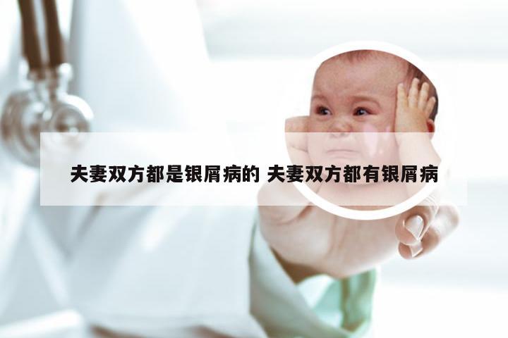 夫妻双方都是银屑病的 夫妻双方都有银屑病