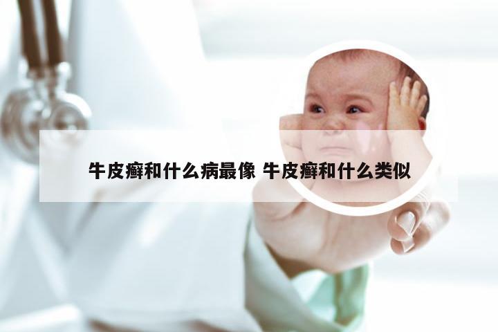 牛皮癣和什么病最像 牛皮癣和什么类似