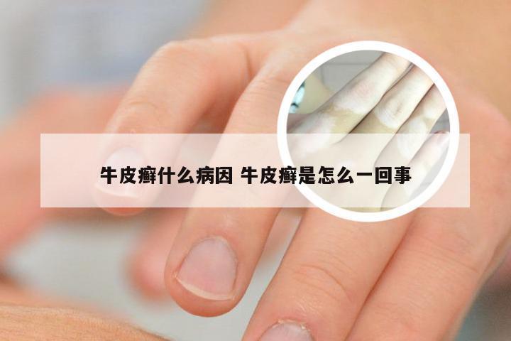 牛皮癣什么病因 牛皮癣是怎么一回事