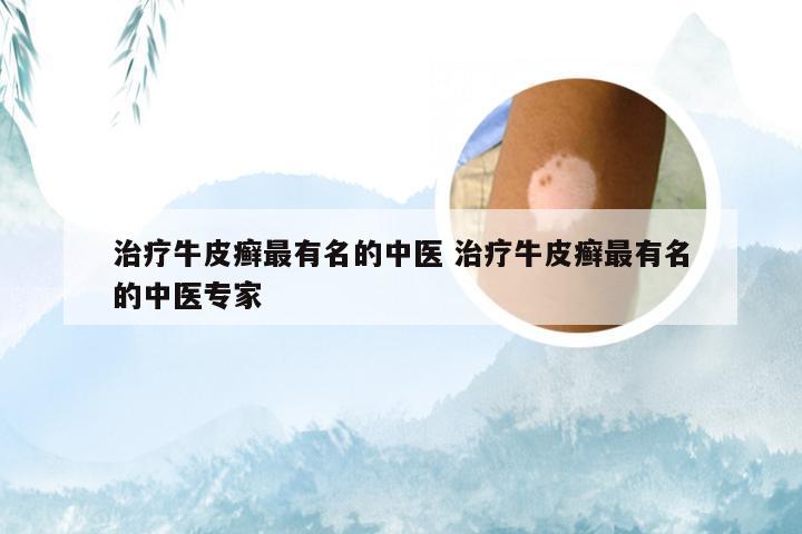 治疗牛皮癣最有名的中医 治疗牛皮癣最有名的中医专家