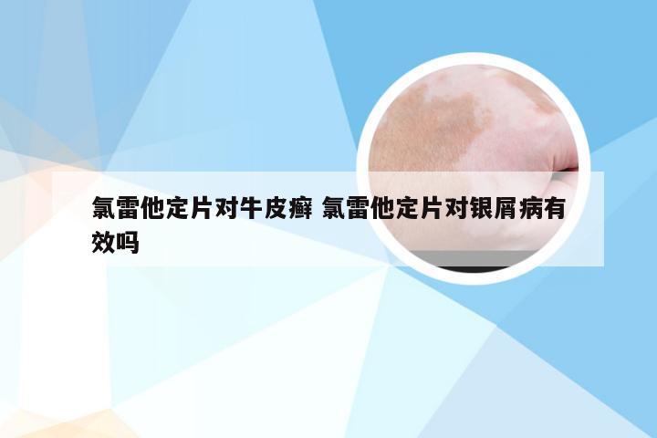 氯雷他定片对牛皮癣 氯雷他定片对银屑病有效吗