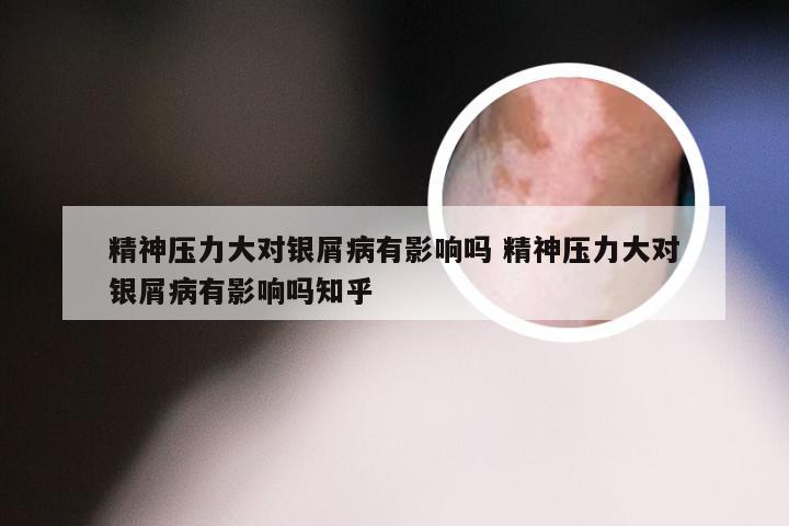 精神压力大对银屑病有影响吗 精神压力大对银屑病有影响吗知乎