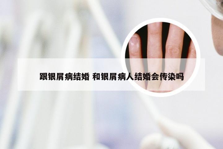 跟银屑病结婚 和银屑病人结婚会传染吗