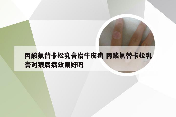 丙酸氟替卡松乳膏治牛皮癣 丙酸氟替卡松乳膏对银屑病效果好吗
