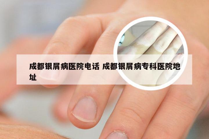 成都银屑病医院电话 成都银屑病专科医院地址