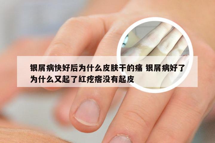 银屑病快好后为什么皮肤干的痛 银屑病好了为什么又起了红疙瘩没有起皮