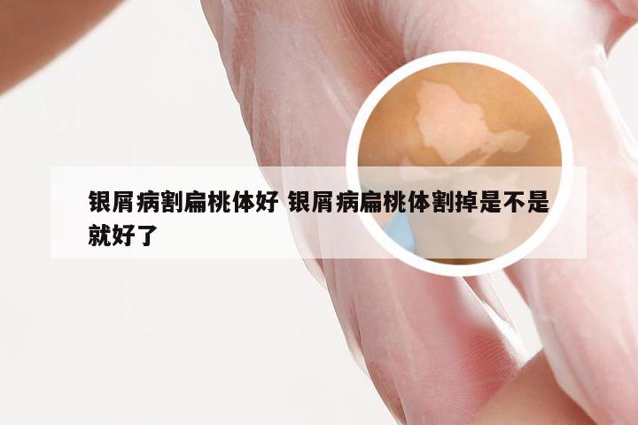 银屑病割扁桃体好 银屑病扁桃体割掉是不是就好了