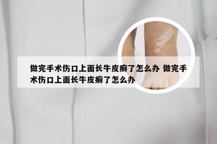 做完手术伤口上面长牛皮癣了怎么办 做完手术伤口上面长牛皮癣了怎么办
