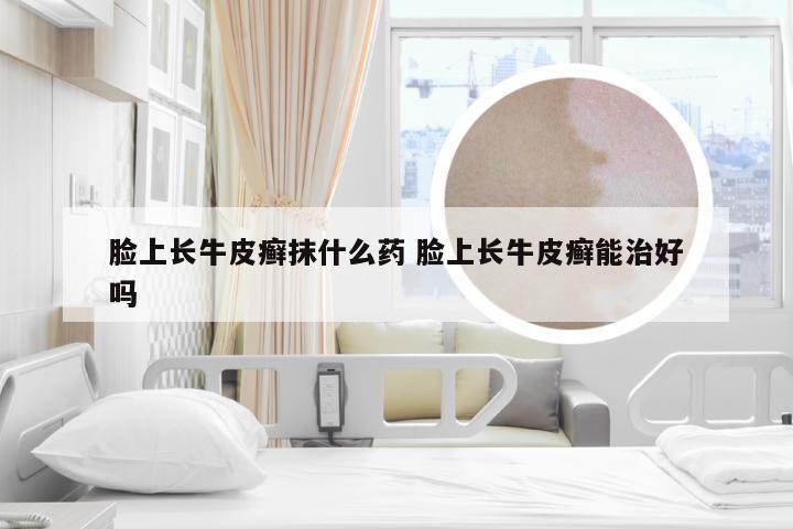 脸上长牛皮癣抹什么药 脸上长牛皮癣能治好吗