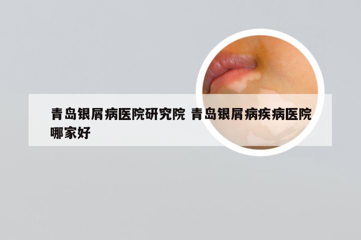 青岛银屑病医院研究院 青岛银屑病疾病医院哪家好