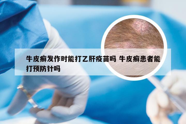 牛皮癣发作时能打乙肝疫苗吗 牛皮癣患者能打预防针吗