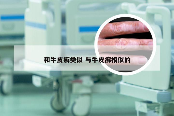 和牛皮癣类似 与牛皮癣相似的