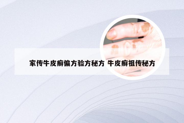 家传牛皮癣偏方验方秘方 牛皮癣祖传秘方