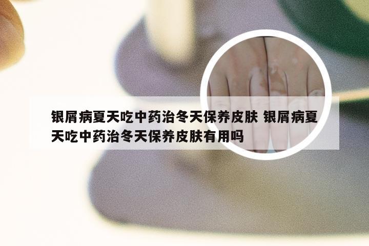 银屑病夏天吃中药治冬天保养皮肤 银屑病夏天吃中药治冬天保养皮肤有用吗