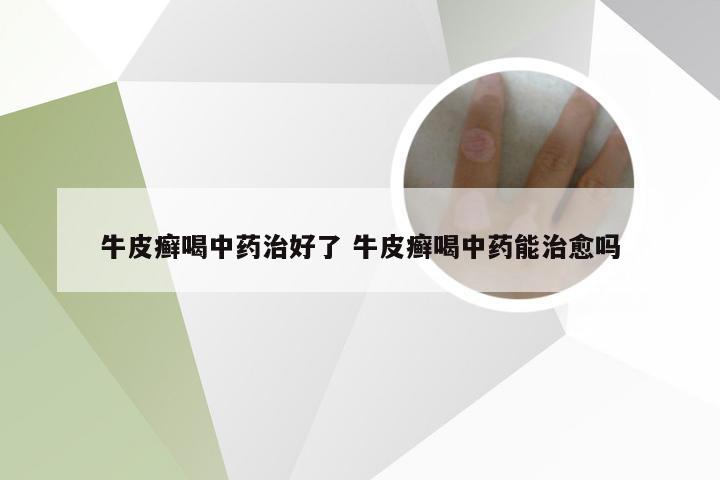 牛皮癣喝中药治好了 牛皮癣喝中药能治愈吗