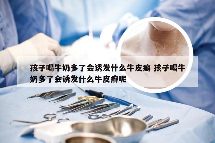 孩子喝牛奶多了会诱发什么牛皮癣 孩子喝牛奶多了会诱发什么牛皮癣呢