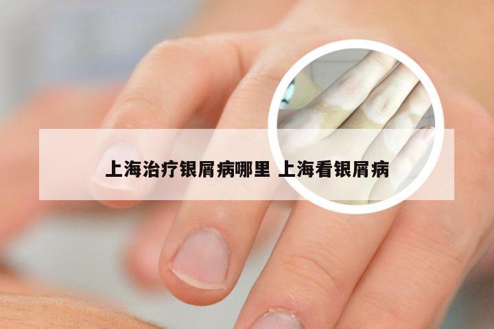 上海治疗银屑病哪里 上海看银屑病