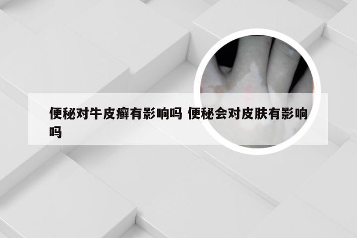便秘对牛皮癣有影响吗 便秘会对皮肤有影响吗