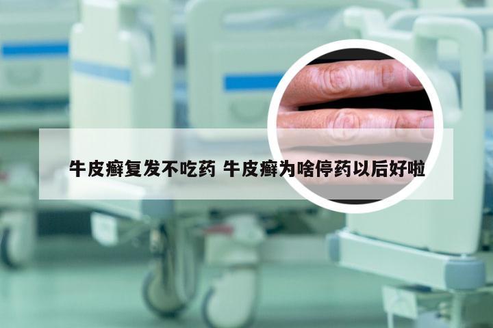 牛皮癣复发不吃药 牛皮癣为啥停药以后好啦