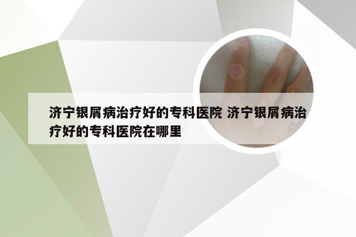 济宁银屑病治疗好的专科医院 济宁银屑病治疗好的专科医院在哪里