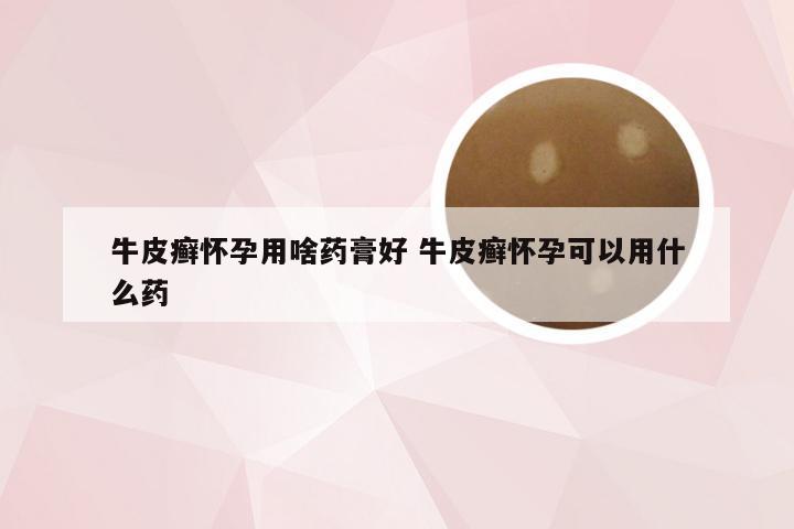 牛皮癣怀孕用啥药膏好 牛皮癣怀孕可以用什么药