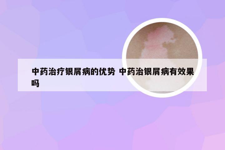 中药治疗银屑病的优势 中药治银屑病有效果吗