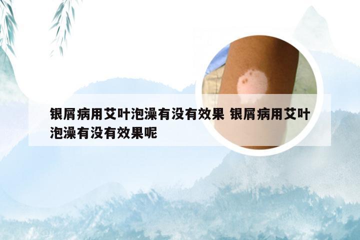 银屑病用艾叶泡澡有没有效果 银屑病用艾叶泡澡有没有效果呢