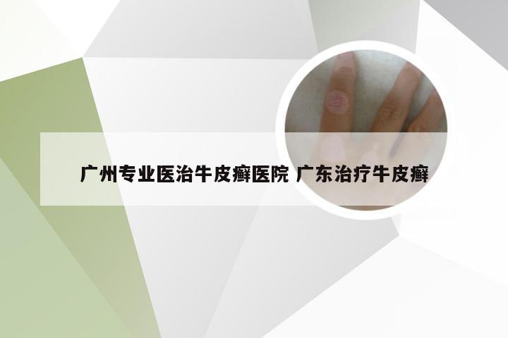 广州专业医治牛皮癣医院 广东治疗牛皮癣