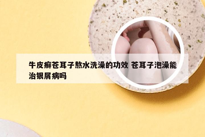 牛皮癣苍耳子熬水洗澡的功效 苍耳子泡澡能治银屑病吗