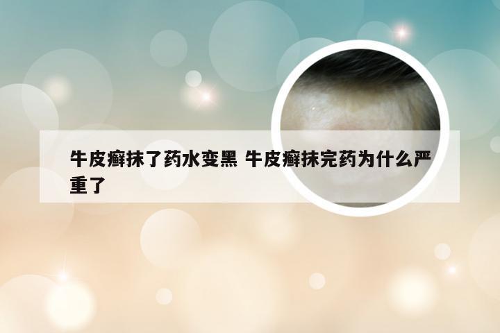 牛皮癣抹了药水变黑 牛皮癣抹完药为什么严重了