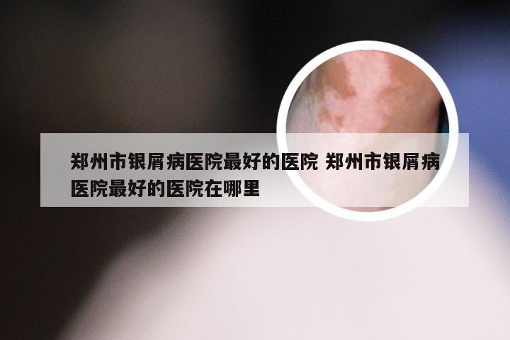 郑州市银屑病医院最好的医院 郑州市银屑病医院最好的医院在哪里