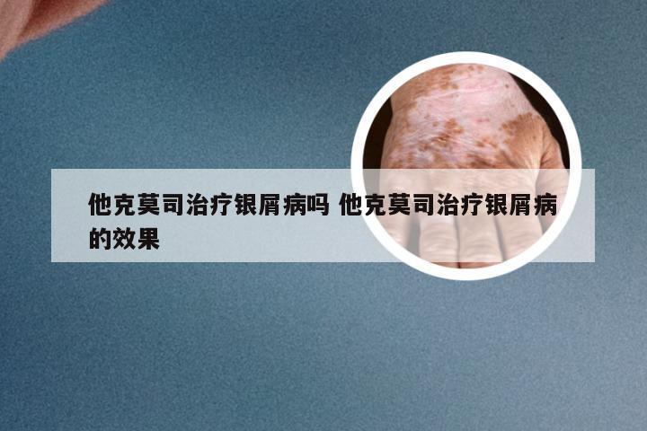 他克莫司治疗银屑病吗 他克莫司治疗银屑病的效果