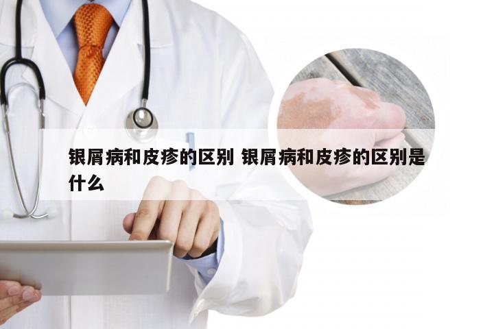 银屑病和皮疹的区别 银屑病和皮疹的区别是什么