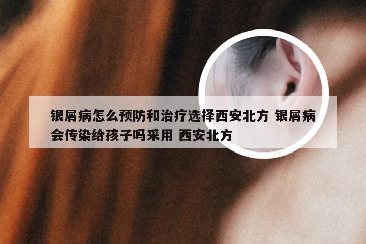 银屑病怎么预防和治疗选择西安北方 银屑病会传染给孩子吗采用 西安北方