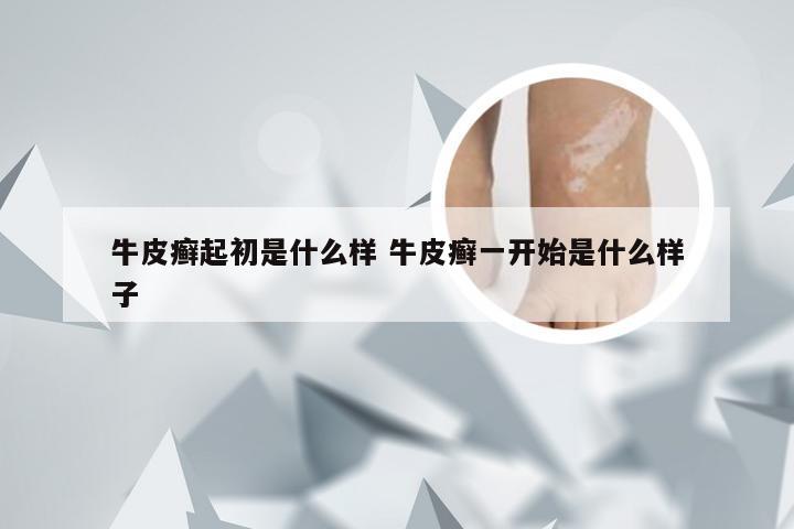 牛皮癣起初是什么样 牛皮癣一开始是什么样子