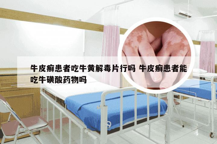 牛皮癣患者吃牛黄解毒片行吗 牛皮癣患者能吃牛磺酸药物吗