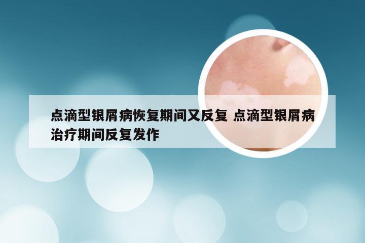 点滴型银屑病恢复期间又反复 点滴型银屑病治疗期间反复发作