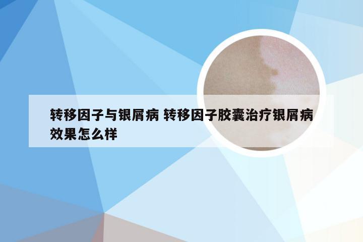 转移因子与银屑病 转移因子胶囊治疗银屑病效果怎么样