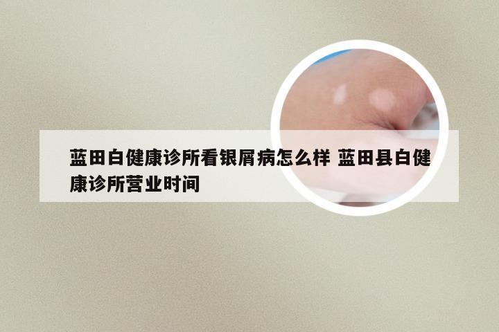 蓝田白健康诊所看银屑病怎么样 蓝田县白健康诊所营业时间