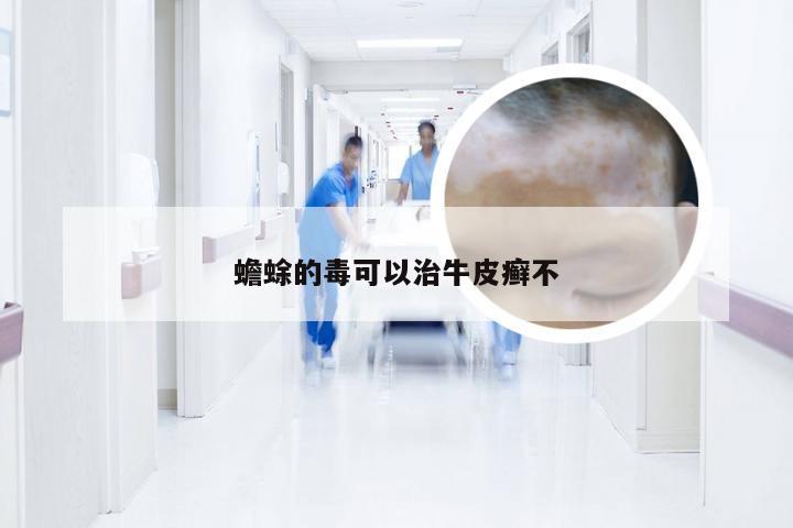 蟾蜍的毒可以治牛皮癣不