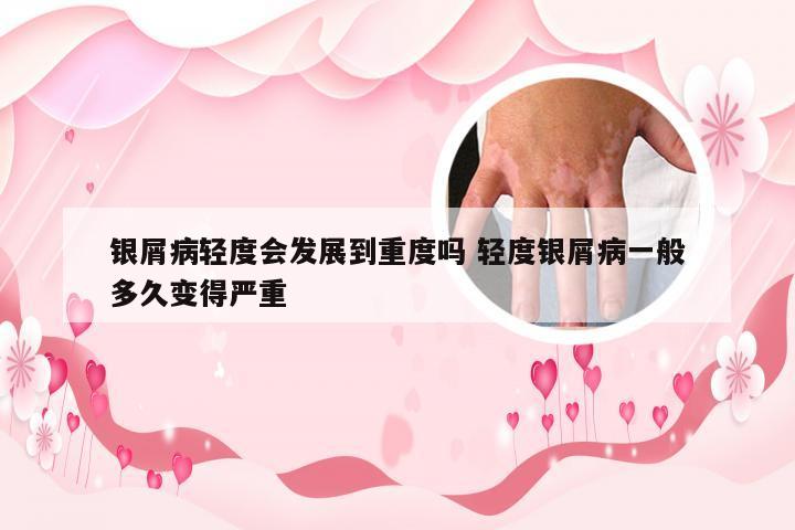 银屑病轻度会发展到重度吗 轻度银屑病一般多久变得严重