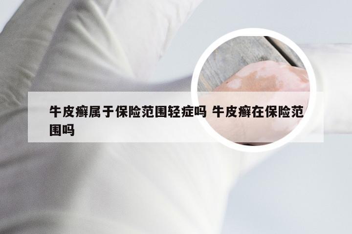 牛皮癣属于保险范围轻症吗 牛皮癣在保险范围吗