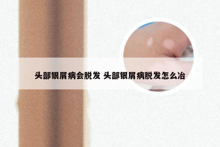 头部银屑病会脱发 头部银屑病脱发怎么冶