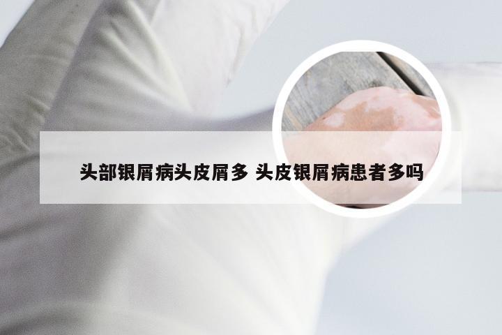 头部银屑病头皮屑多 头皮银屑病患者多吗