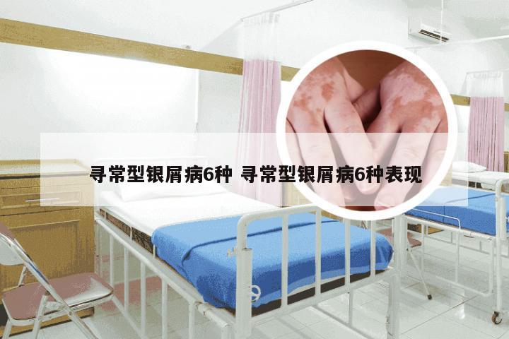 寻常型银屑病6种 寻常型银屑病6种表现