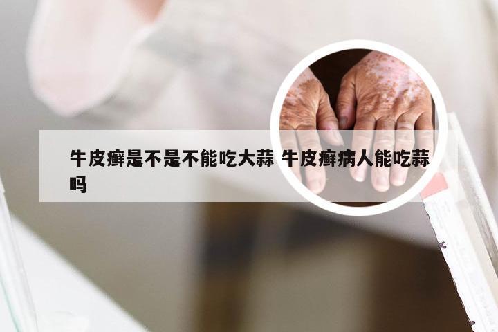 牛皮癣是不是不能吃大蒜 牛皮癣病人能吃蒜吗