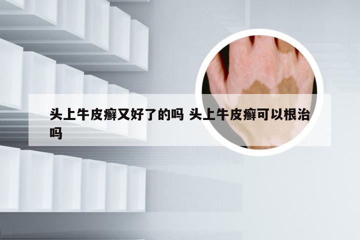 头上牛皮癣又好了的吗 头上牛皮癣可以根治吗