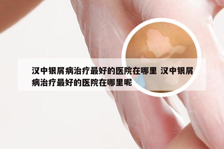 汉中银屑病治疗最好的医院在哪里 汉中银屑病治疗最好的医院在哪里呢