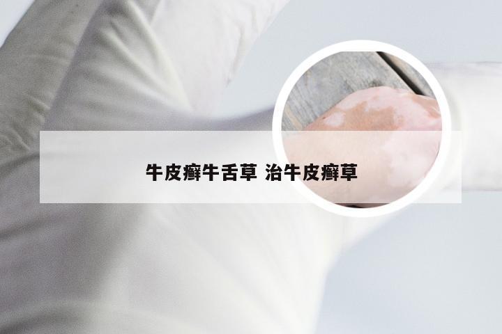 牛皮癣牛舌草 治牛皮癣草